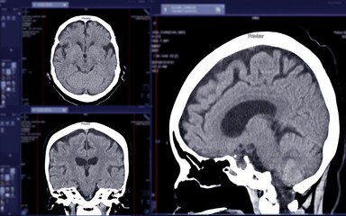 CT scan of the brain