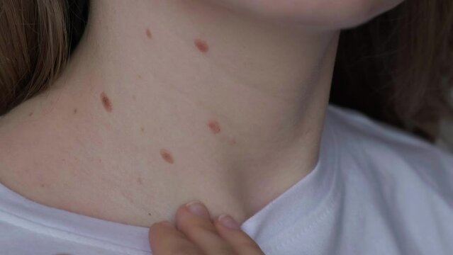 Unrecognizable woman showing her Birthmarks on skin Close up detail of the bare skin Sun Exposure effect on skin, Health Effects of UV Radiation Woman with birthmarks Pigmentation and lot of