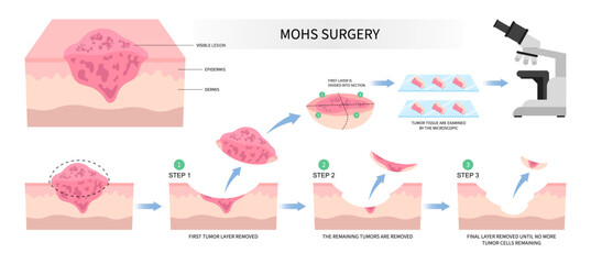 Mohs surgery basal cell microscopic reconstruction Paget's disease inflammation biopsy - obrazy, fototapety, plakaty