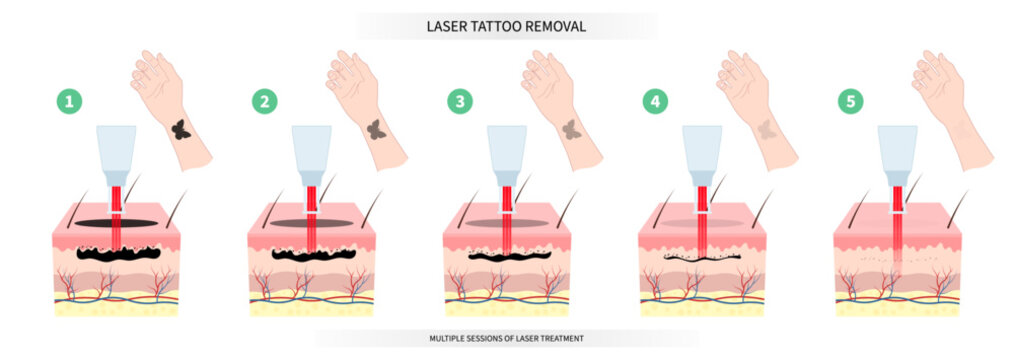 Various stages of skin tattoo remove surgery on hand