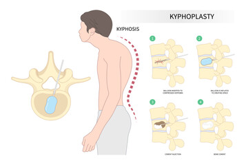 kyphoplasty spine of dowager’s hump disease posture hunched back bone disk joint neck pain surgical degeneration over backbone vertebral column - obrazy, fototapety, plakaty
