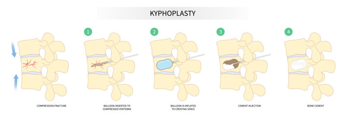 degeneration disk disease with kyphoplasty spine of dowager’s hump posture hunched back bone joint neck pain surgical over backbone vertebral column