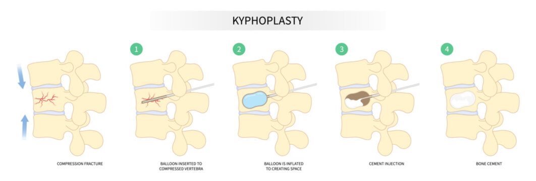 degeneration disk disease with kyphoplasty spine of dowager’s hump posture hunched back bone joint neck pain surgical over backbone vertebral column