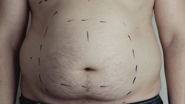 The plastic surgeon doctor makes marks with a marker on the belly of a male patient to remove fat and reduce the abdomen. Liposuction on the abdomen, overweight, close-up