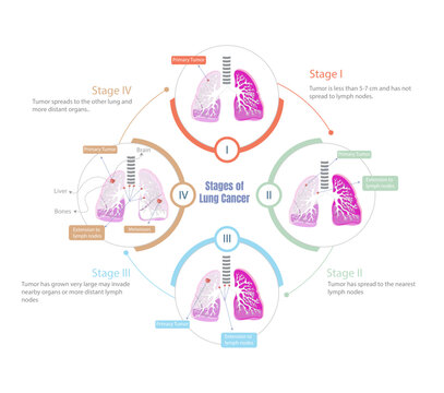 Stages of lung cancer. Process of how it progresses in all its stages.