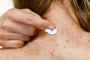 Woman with pimple on back applying medical ointmeny