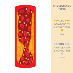 Narrowed blood vessel with cholesterol plaque buildup. Artery blocked with a fat cells clot. ldl and hdl lipoprotein comparison. Cross section medical diagram. Vector illustration.