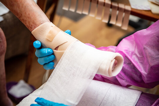 Epidermolysis bullosa, Krankenschwester verbindet den Fu&szlig;