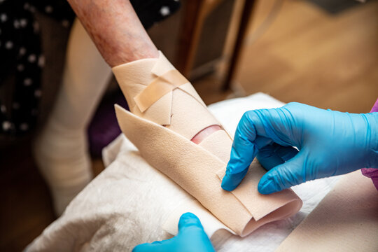 Epidermolysis bullosa, Krankenschwester verbindet den Fu&szlig;