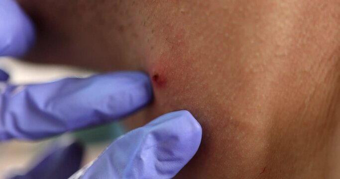 Hands of doctor in gloves examining white red pimple on skin