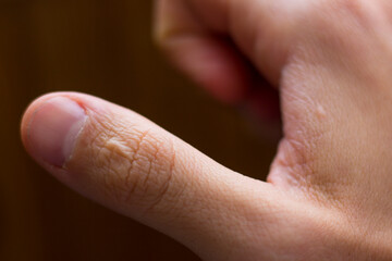 Scar, damage to the thumb close-up