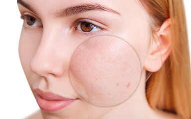 Young woman with zoom circle before and after treatment or retouch. Beautician concept.