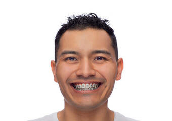 face of a young Latino man with dark skin smiles at the camera, shows if orthodontic treatment, stainless steel braces and garters