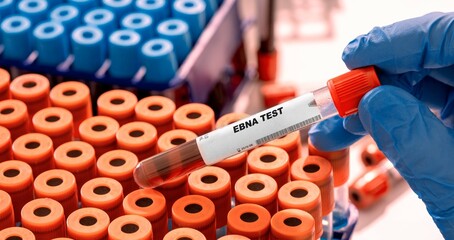 EBNA test tube with blood sample in infection lab