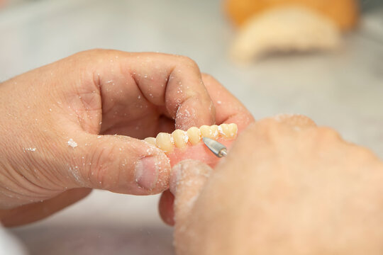 Manufacturing of dentures. Orthopedist's hands make jaw prostheses.