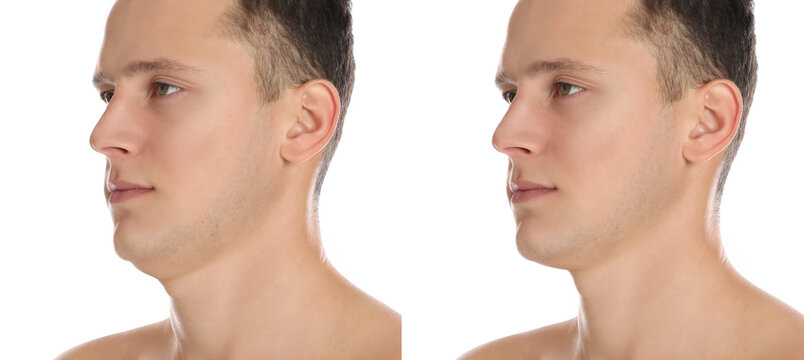 Double chin problem. Collage with photos of man before and after plastic surgery procedure on white background, banner design