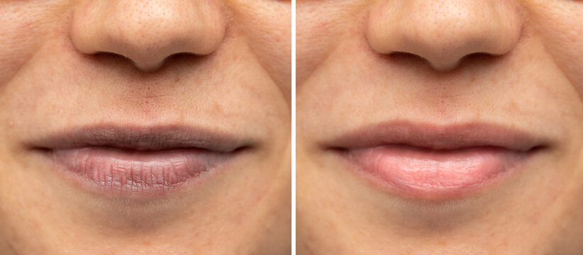 before and after a treatment for aged lips