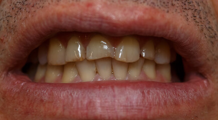 Human front teeth for prosthetics with ceramic veneers. Teeth before treatment. Chipped enamel of...