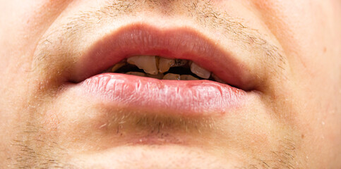 Broken teeth in a man close-up. Chipped teeth. Dental problems with teeth. Restoration and implantation of teeth.