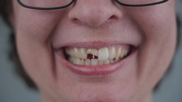 Smiling Young Caucasian Woman With Broken Front Tooth From Which Fiberglass Pins Sticking Out. Tooth Injury, Chipped Tooth Half After Accident. Dentistry And Maxillofacial Treatment. Dental Trauma.