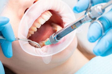 The dentist injects an anesthetic into the patient's inner cheek. Anesthetic drug in dentistry