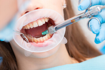 The dentist injects an anesthetic into the patient's inner cheek. Anesthetic drug in dentistry