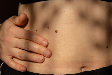 Birthmarks on skin Close up detail of the bare skin Sun Exposure effect on skin, Health Effects of...