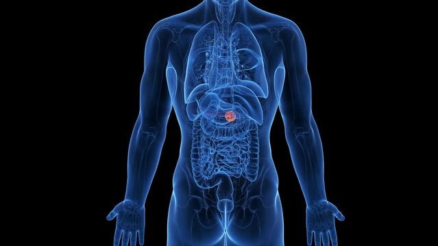 3d rendered medical animation of a pancreas tumor