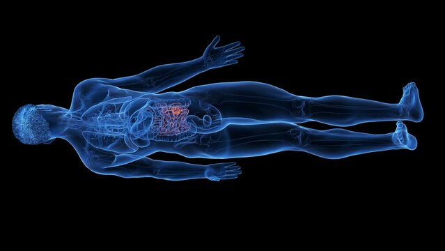 3d rendered medical animation of a small intestine tumor