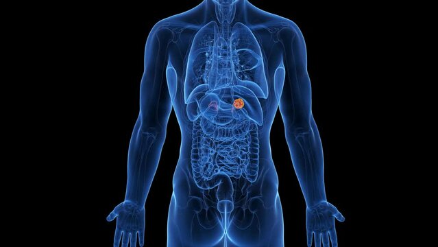 3d rendered medical animation of an adrenal gland tumor