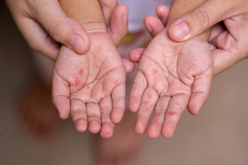 Parents hold the hands of a child with HFMD - obrazy, fototapety, plakaty