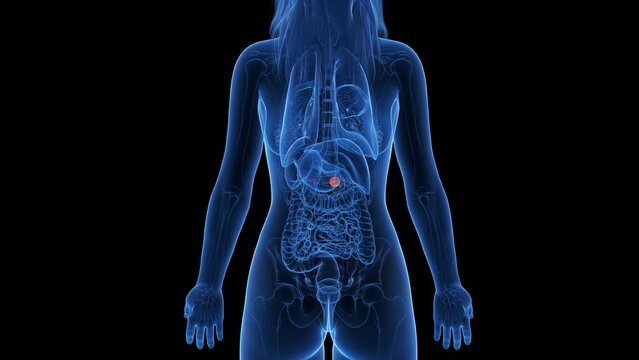 3d rendered medical animation of a breast tumor