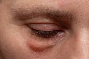Fototapeta premium Swollen eyes from tiredness and irritation