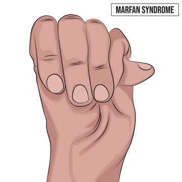 Marfan syndrome affects the heart, eyes, blood vessels, and bones. People with Marfan syndrome are tall and thin, and have long arms, legs, and fingers.