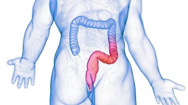 3d rendered medical animation of colitis ulcerosa