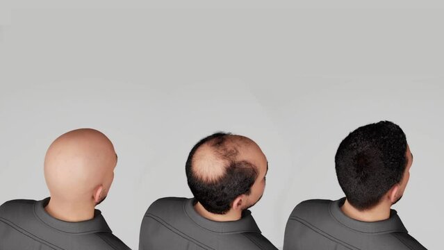 3D Render and 3D illustration Man before after hair loss treatment. Head balding man before after hair. 
