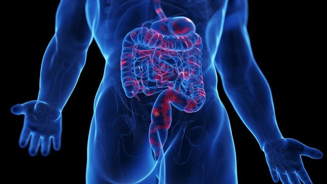 3d rendered medical animation of the colon of a man suffering from crohns disease