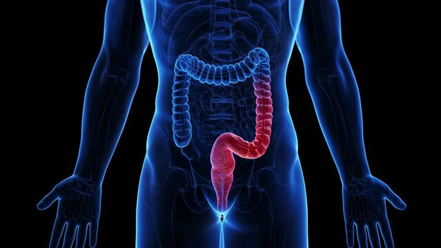 3d rendered medical animation of the colon of a man suffering from colitis ulcerosa