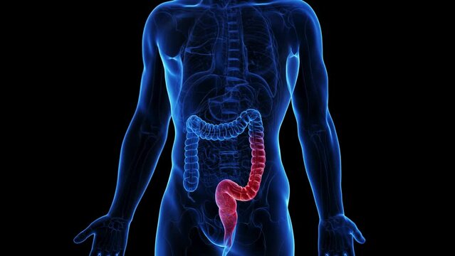 3d rendered medical animation of the colon of a man suffering from colitis ulcerosa