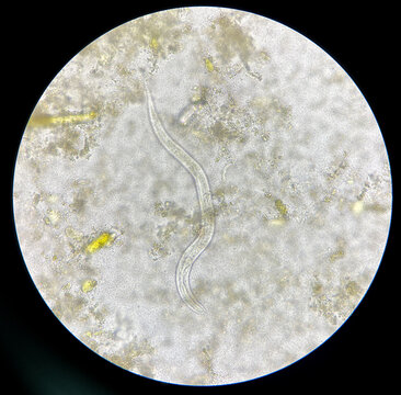 strongyloides stercoralis larva in stool exam.
