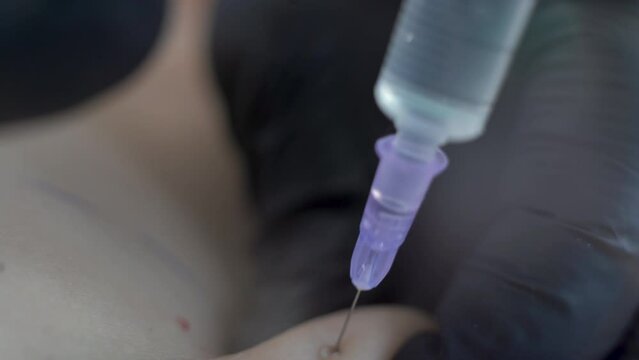 Close up of doctor of aesthetic cosmetology makes lipolytic injections to burn body fat on a womans stomach and body. Female aesthetic cosmetology