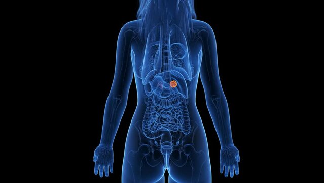 3d rendered medical animation of an adrenal gland tumor