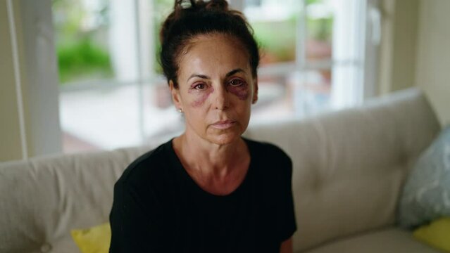 Middle age hispanic woman suffering for domestic violence with bruise on eyes at home