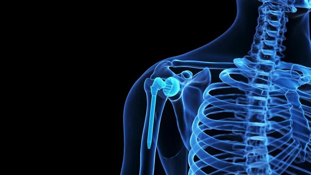 3d rendered medical animation of a shoulder replacement