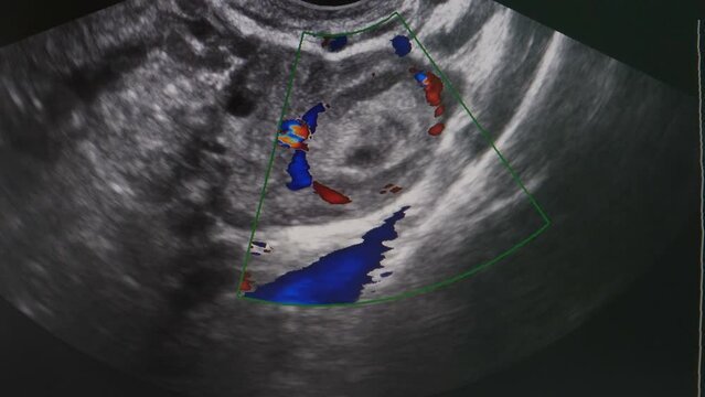 Gynecology ultrasonic investigation. Shot from screen of ultrasound device. Doctor gynecologist treating patient in modern medical clinic. Sonography result of female genitourinary system in