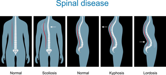 Normal spine and Spinal deformity from Scoliosis to Lordosis and Kyphosis. - obrazy, fototapety, plakaty