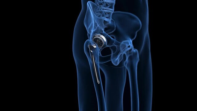 3d rendered medical animation of a hip replacement