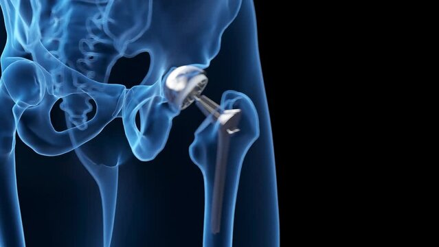 3d rendered medical animation of a hip replacement