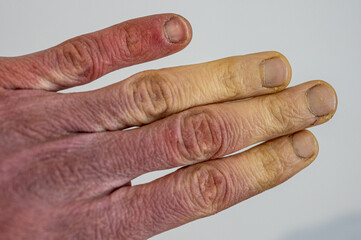 A frostbitten male hand with Raynaud's syndrome, Raynaud's phenomenon or Raynaud's disease.