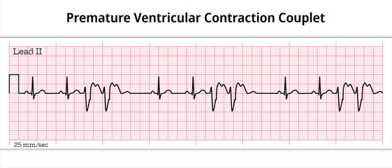 ECG Premature Ventricular Contraction Couplet - 8 Second ECG Paper